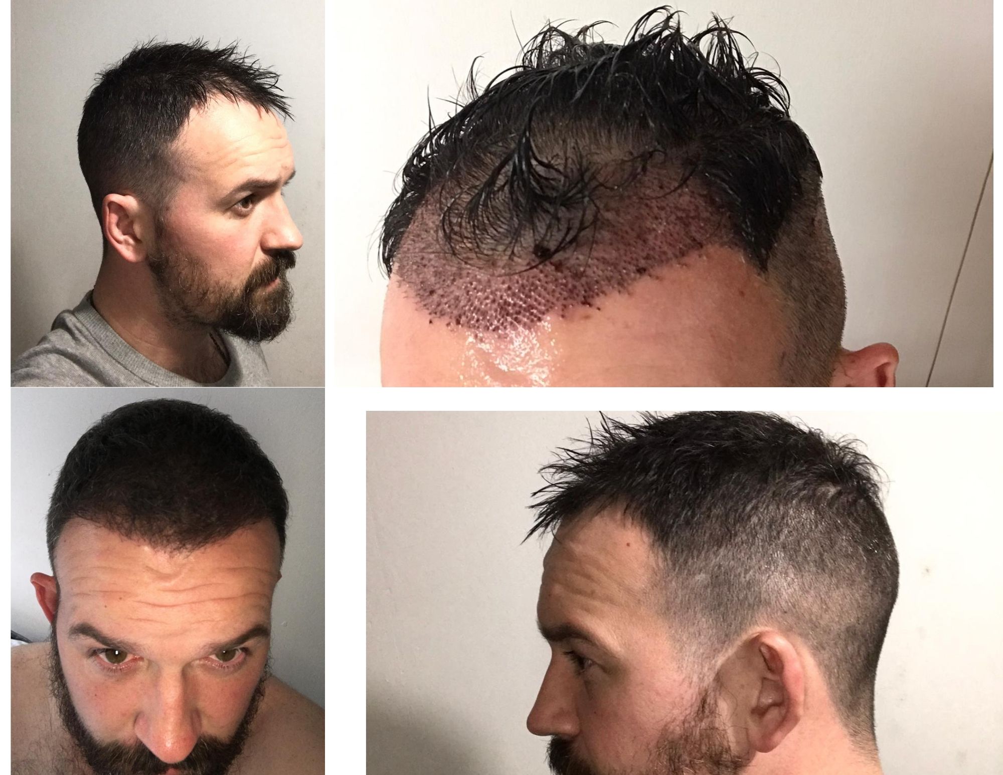 Is a hair transplant permanent?