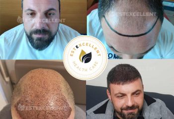 Man Hair Loss Problem And Treatment (Hair Transplant)