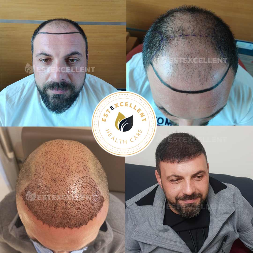 Man Hair Loss Problem And Treatment (Hair Transplant)