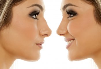 NOSE AESTHETIC SURGERY Rhinoplasty