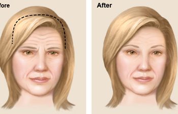 WHICH TECHNIQUE IS BEST BROW LIFTS or Forehead lift? DIFFERENT TYPES OF BROW LIFTS