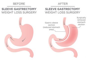 How Bariatric Surgery can change your life?