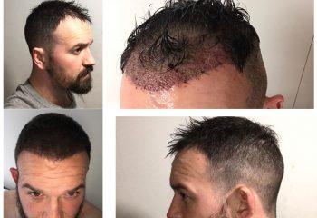 Is a hair transplant permanent?