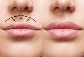 What is a lip lift?