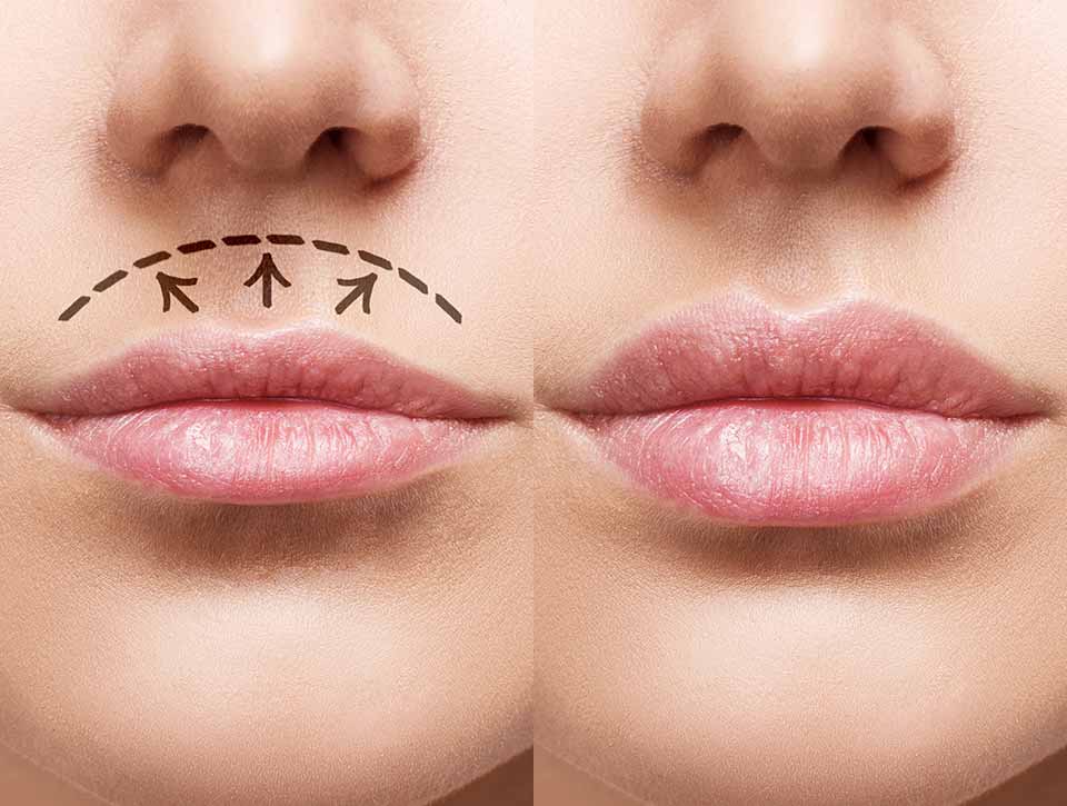 What is a lip lift?