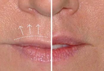 Lip Lift Surgery