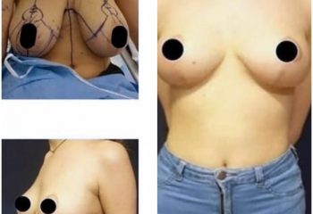 Breast Reduction Surgery in the UK (United Kingdom)