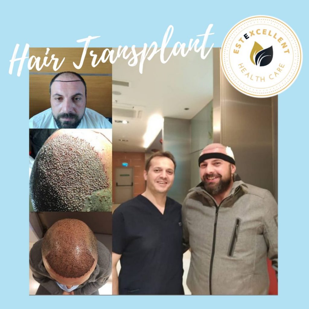 hair transplantation (1)